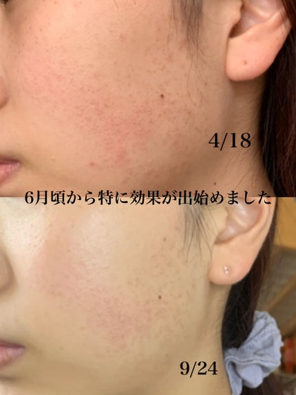 カプセルレシピパック N B&A/innisfree/洗い流すパック・マスクを使ったクチコミ(3枚目)