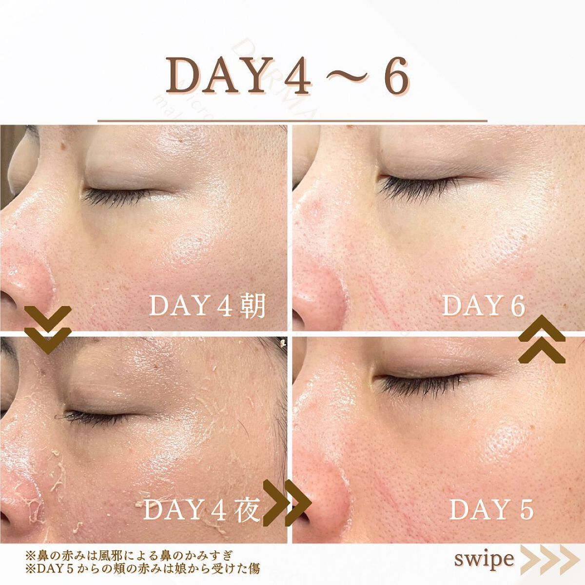 ダーマスキンピーリング/BQCELL/その他キットセットを使ったクチコミ(6枚目)