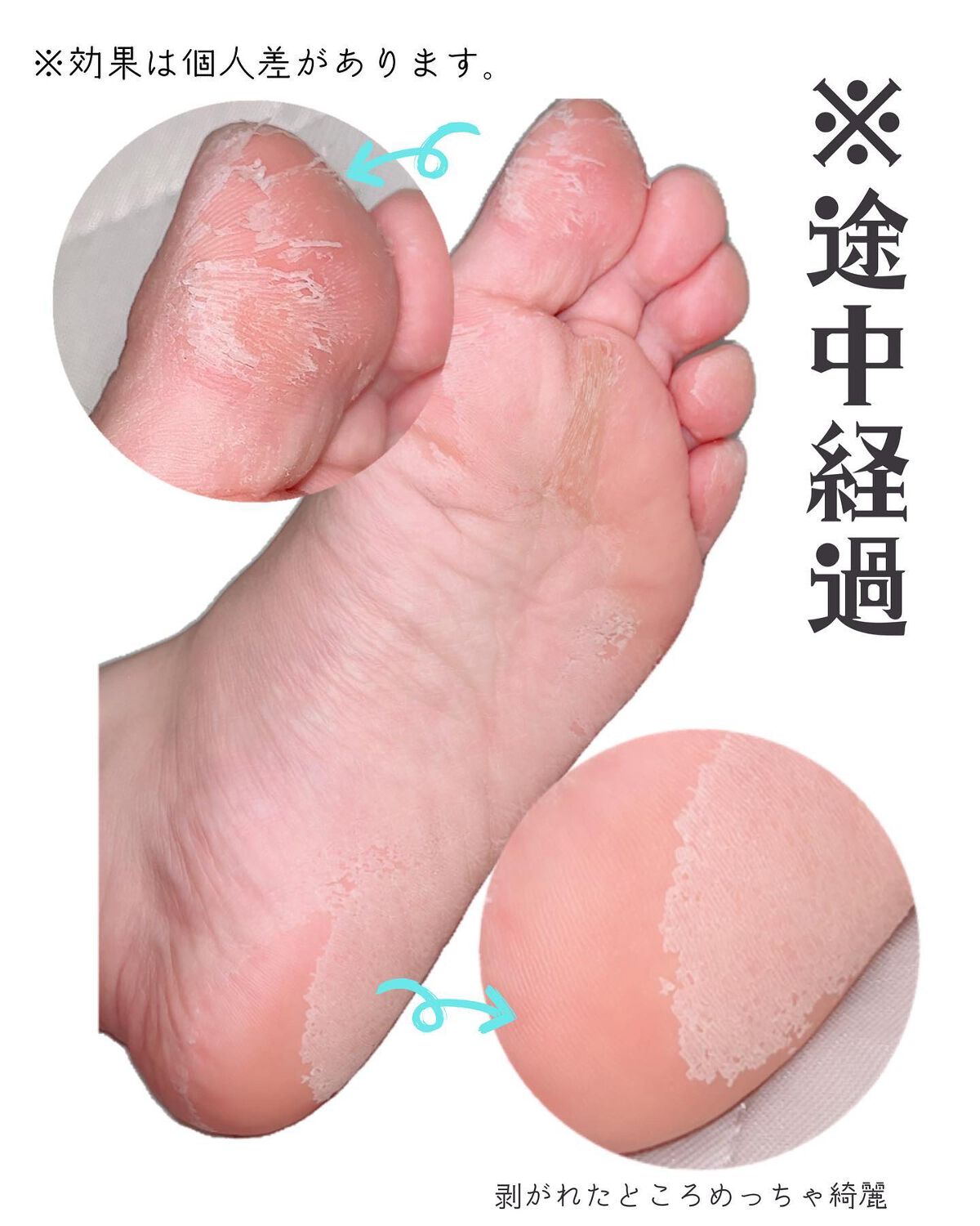 イージーパックSPT 30分タイプ/ベビーフット/レッグ・フットケアを使ったクチコミ(2枚目)