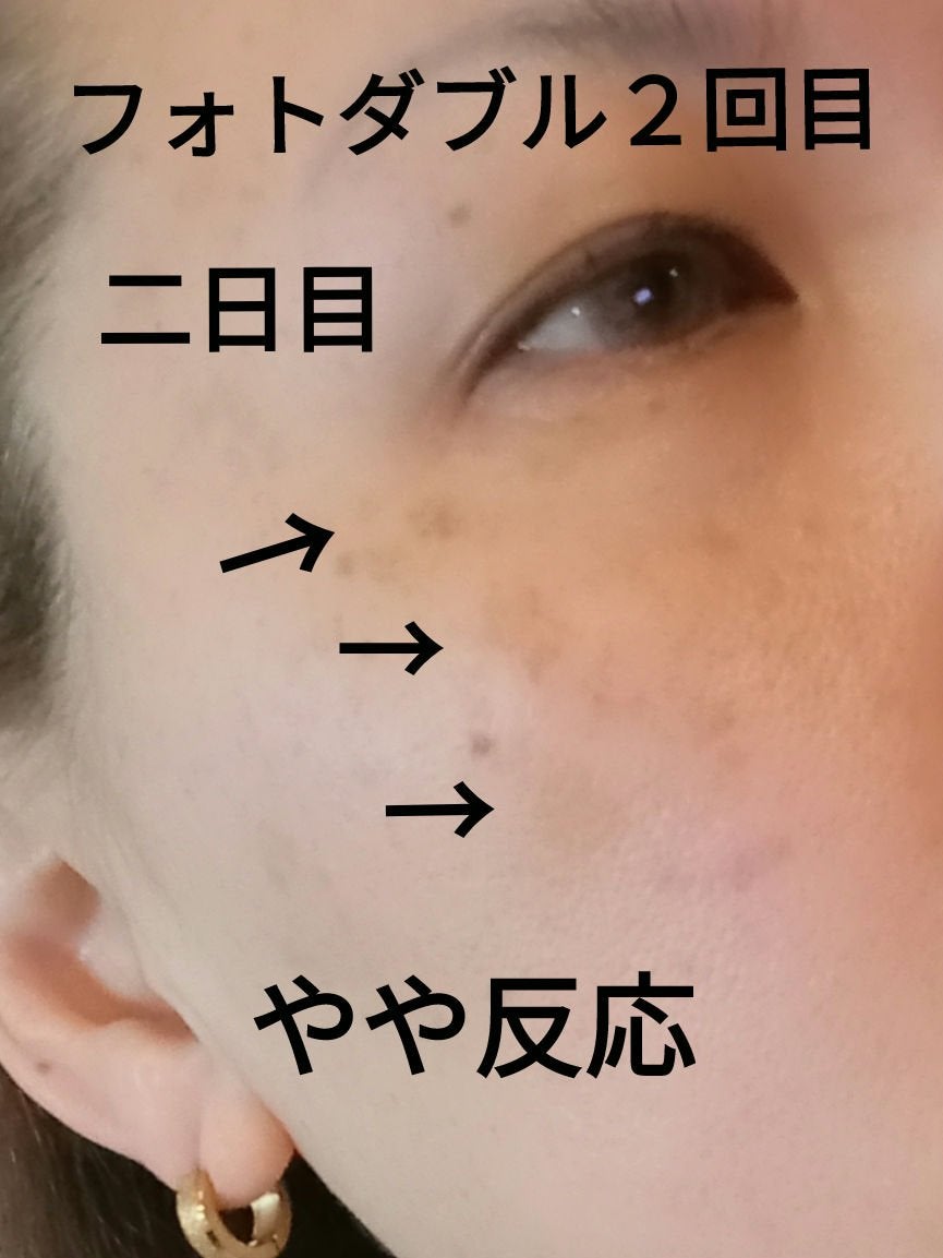 ビヨンセ奥二重向上委員長🥸LIPSパートナー🥳 on LIPS 「フォトダブル施術後二日目。一回目より反応しないけど効果がないわ..」(1枚目)