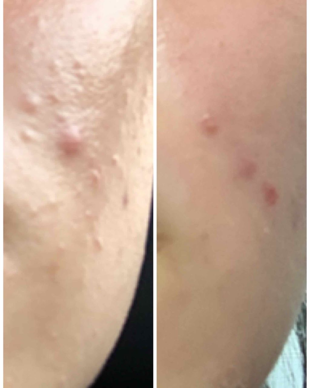 エピデュオゲル/マルホ株式会社/その他を使ったクチコミ（1枚目）