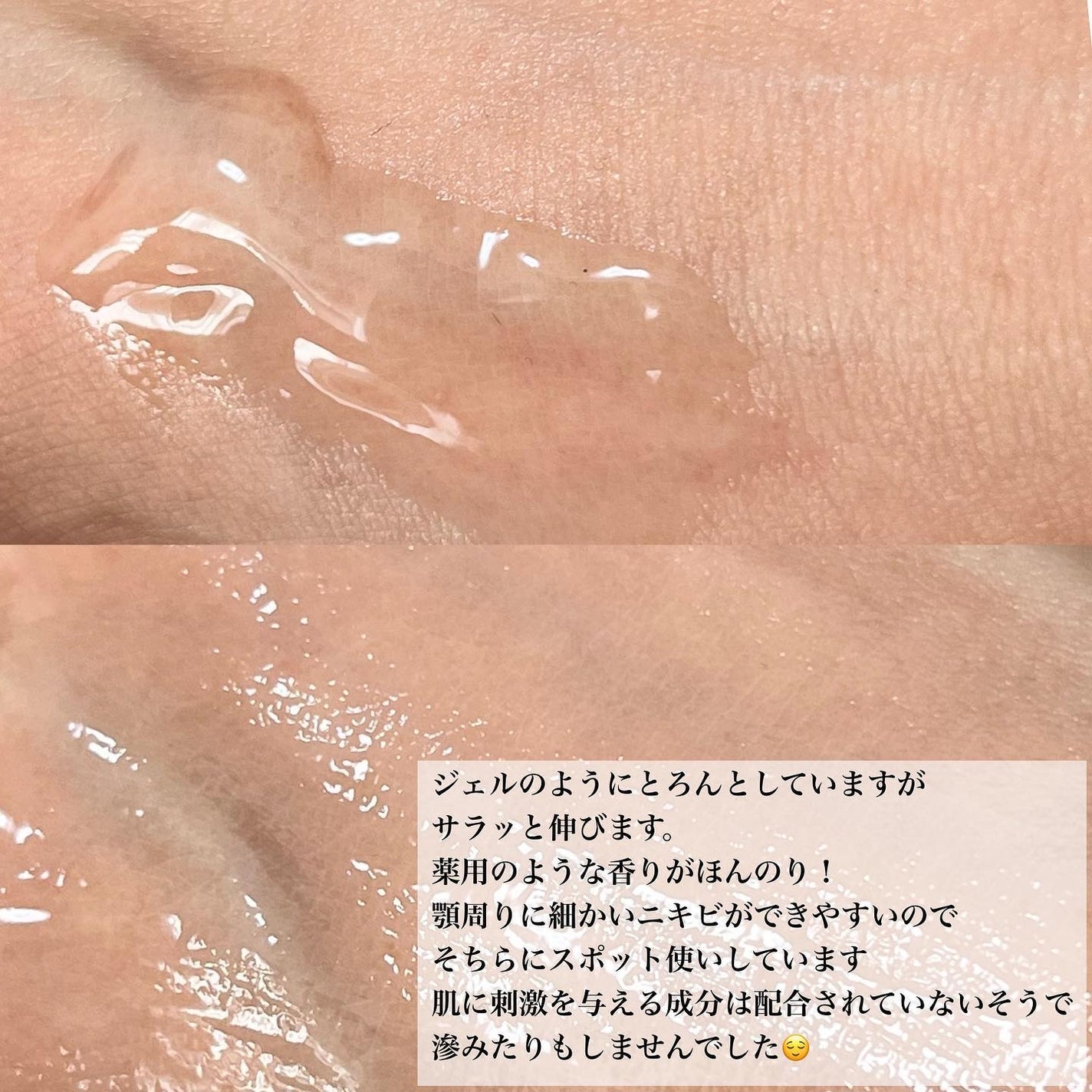 アクニドクターファーストスピーディースポット/ISOI/美容液を使ったクチコミ(3枚目)