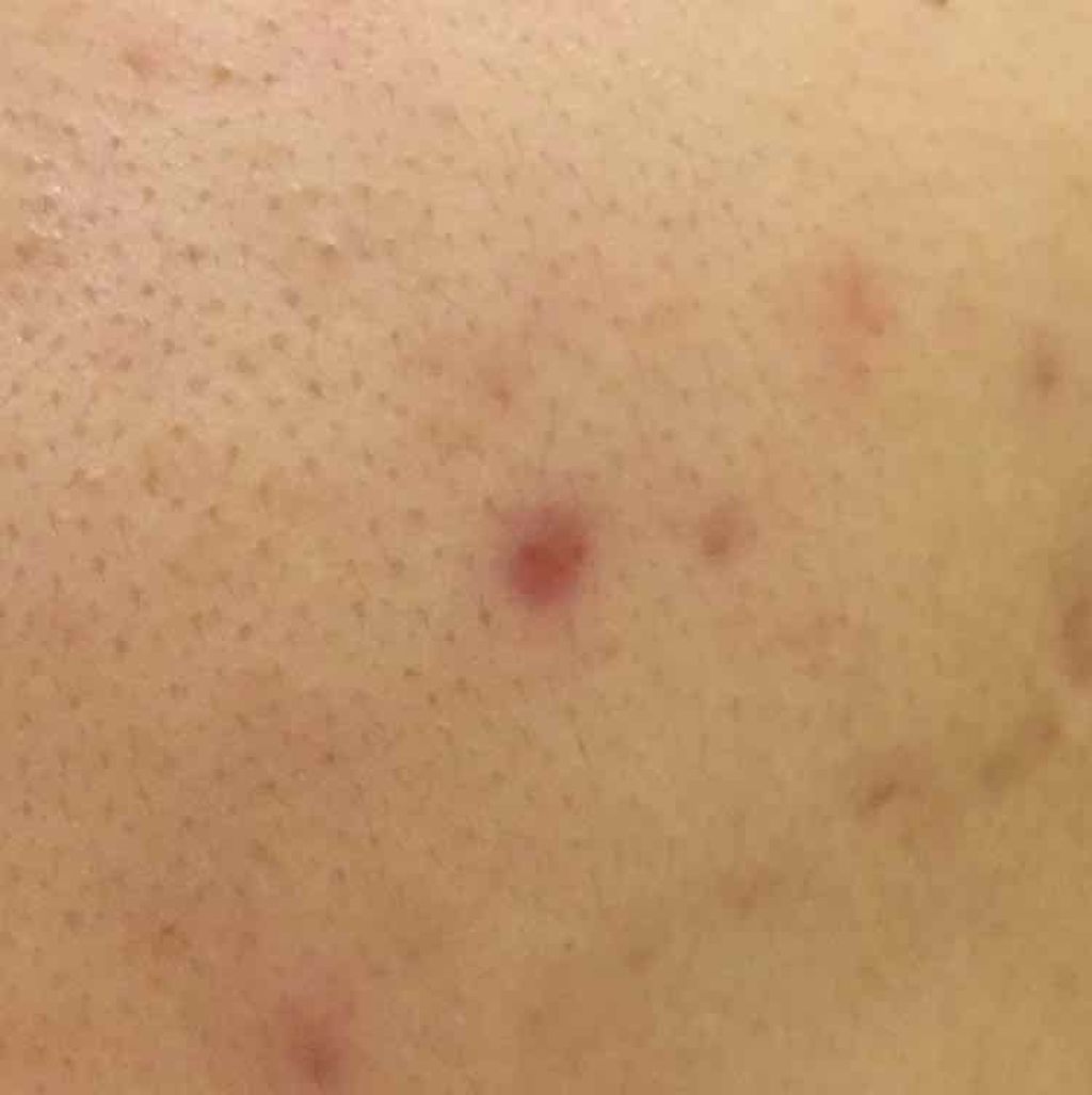 薬用 しみ 集中対策 美容液/メラノCC/美容液を使ったクチコミ（2枚目）