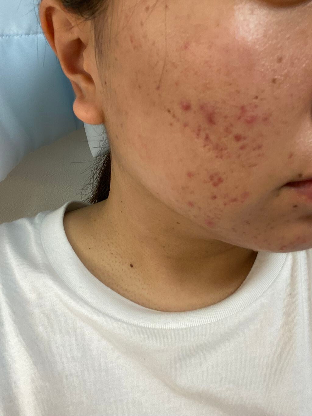 もち on LIPS 「こんばんは!約1週間ぶりです全くニキビが良くなりません。もうす..」(2枚目)