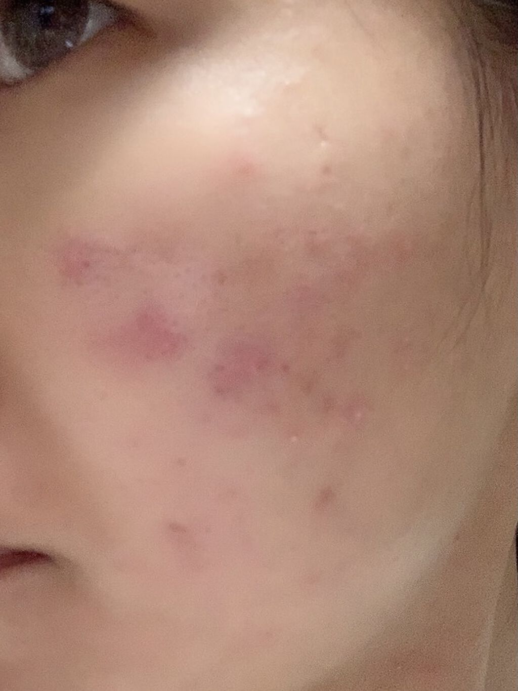 アクアチムローション、アクアチムクリーム(医薬品)/大塚製薬/その他を使ったクチコミ（3枚目）