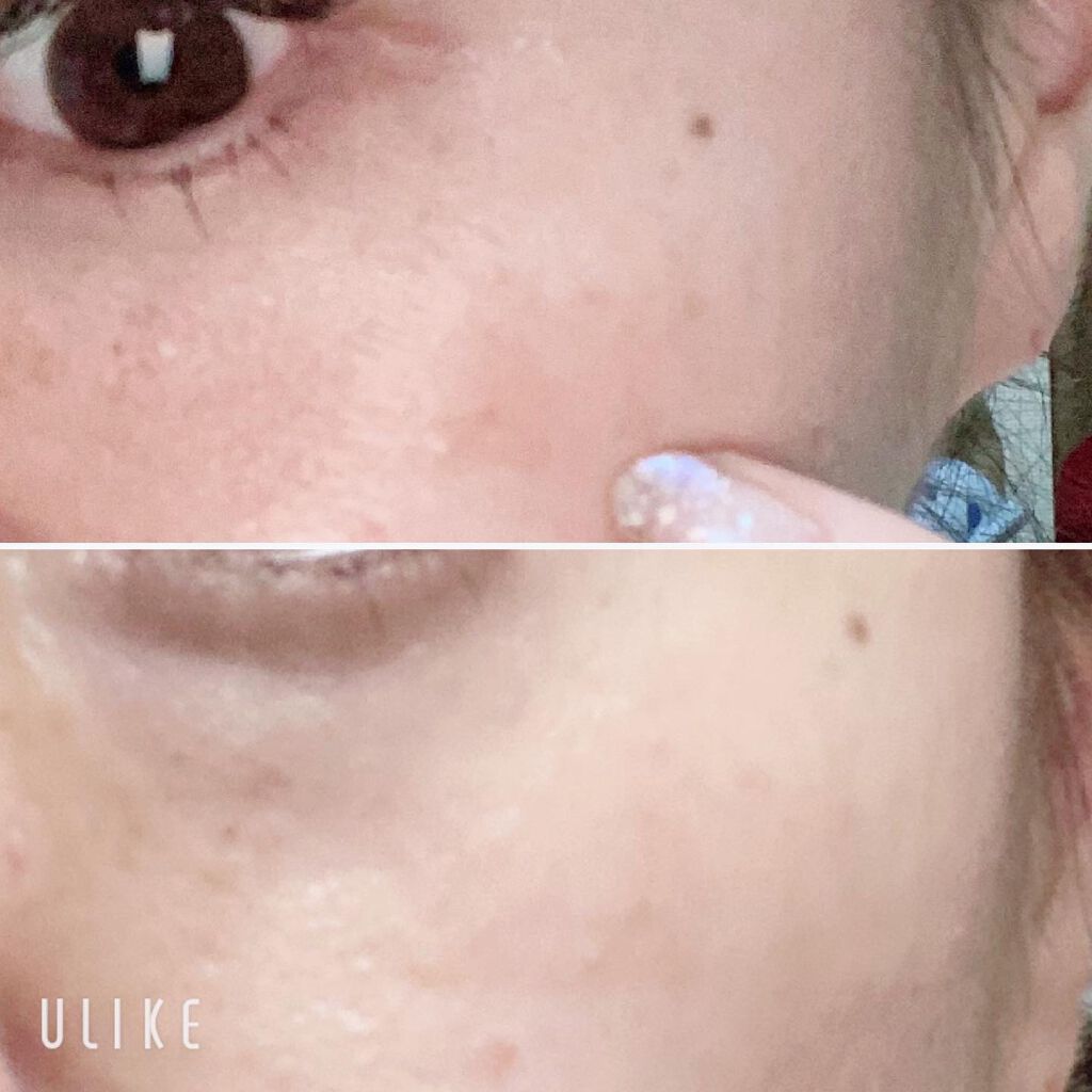 ちっちみ on LIPS 「。*♡……♡*。。*♡……♡*。シミ取りカウンセリングに行った..」(2枚目)