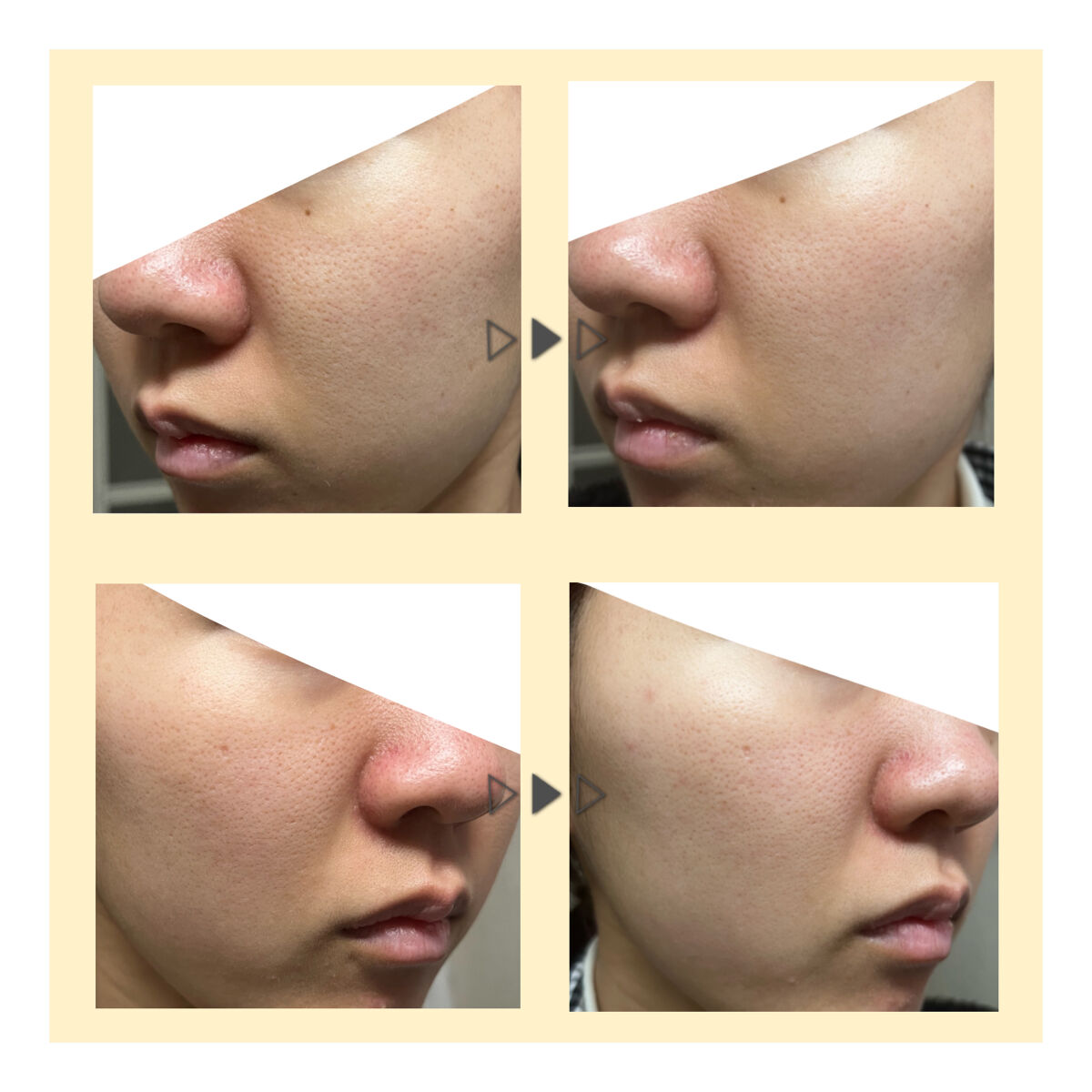 V エッセンス/unlabel/美容液を使ったクチコミ（3枚目）