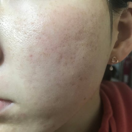 Amino Acid+B5/The Ordinary/美容液を使ったクチコミ(2枚目)