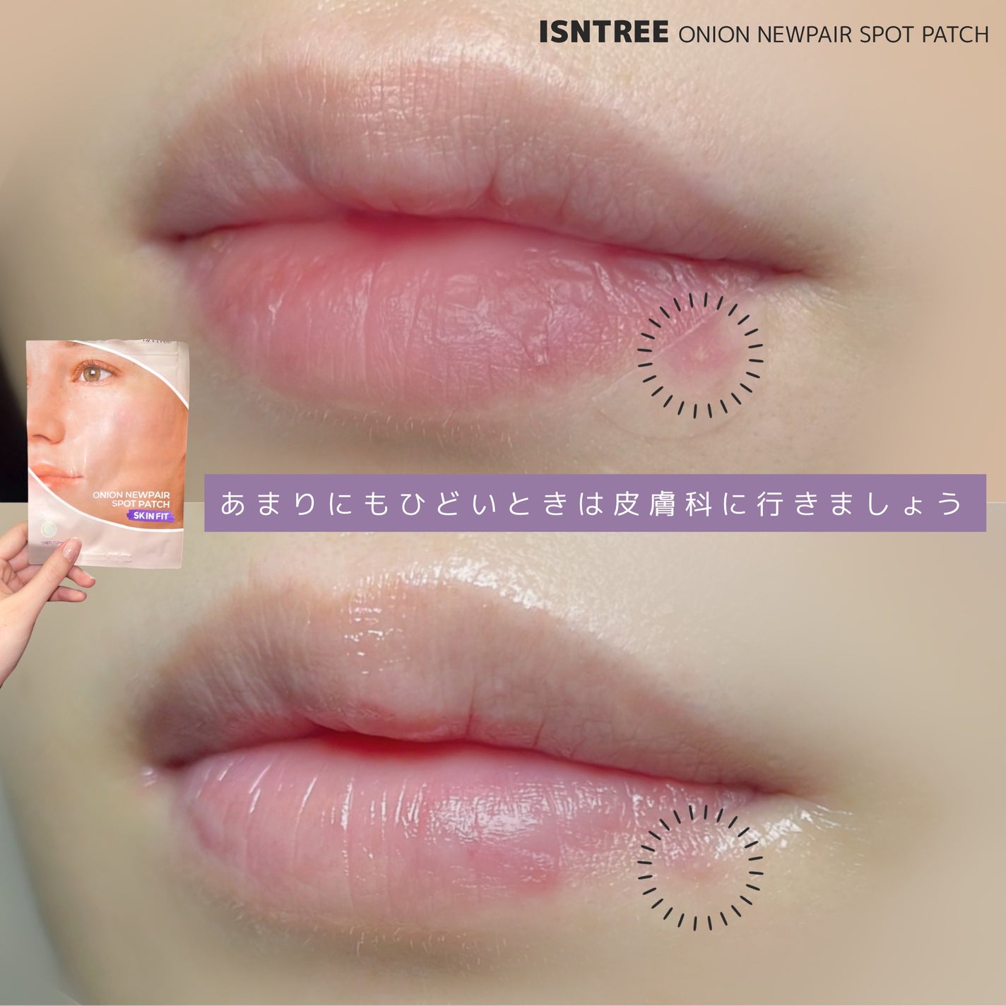 オニオンニューペアスポットパッチ スキンフィット/Isntree/にきびパッチを使ったクチコミ(5枚目)
