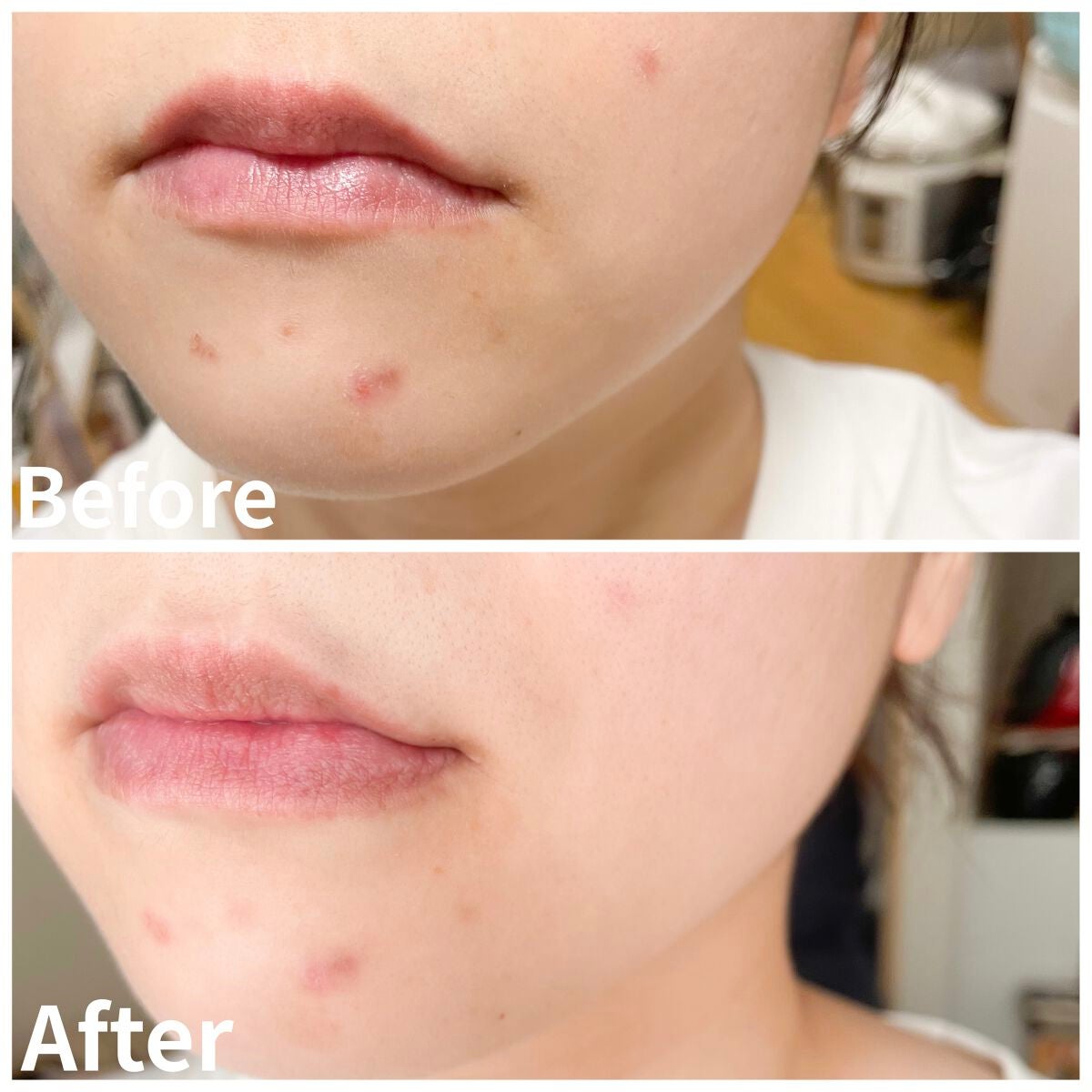 ACケア/ACROPASS/シートマスク・パックを使ったクチコミ(4枚目)