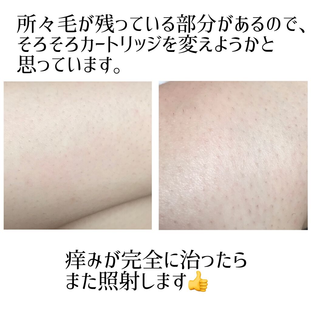 光美容器KE-NON(ケノン)/エムテック/家庭用脱毛器を使ったクチコミ(5枚目)