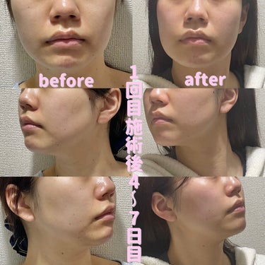 Tomomi on LIPS 「はじめての美容医療〜脂肪溶解リニアHIFU〜1回目施術後4~7..」（3枚目）