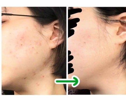 <ジャスミーカラー>エッセンスファンデーション/COVERMARK/クリーム・エマルジョンファンデーションを使ったクチコミ(2枚目)