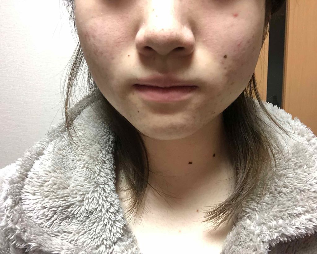 バイオイル/バイオイル/フェイスオイルを使ったクチコミ（2枚目）