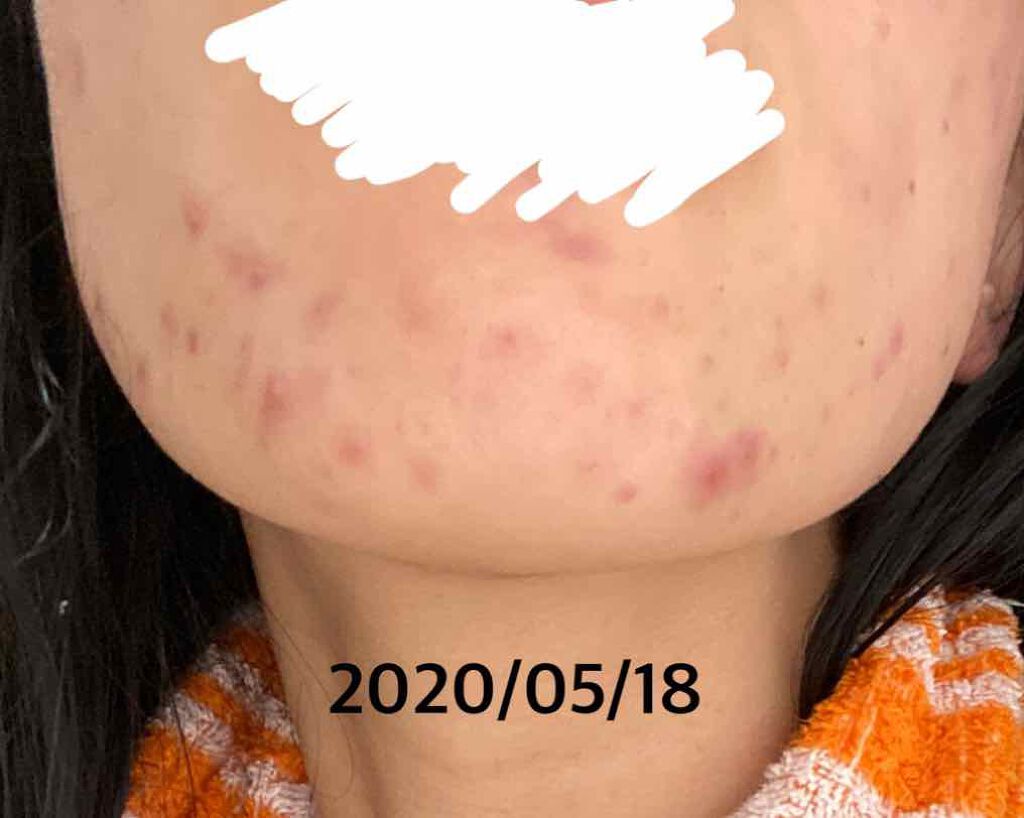 クラリファイング ローション 2/CLINIQUE/拭き取り化粧水を使ったクチコミ(3枚目)