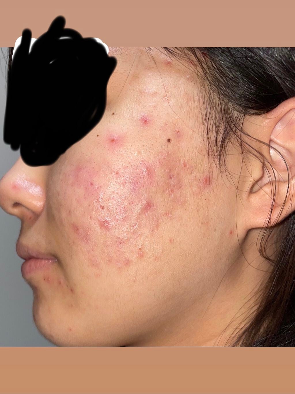 a on LIPS 「⚠️注意⚠️⚠️注意⚠️助けてください!!肌が今最大級に荒れて..」(2枚目)