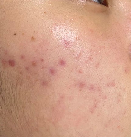 パル on LIPS 「初投稿ですニキビがひどくて困ってます😭高2の夏頃からどんどんど..」(2枚目)