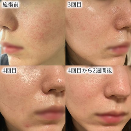 甘皮 on LIPS 「【肌荒れ治療記】美容クリニックに通ってみた結果線の内側は前置き..」(6枚目)