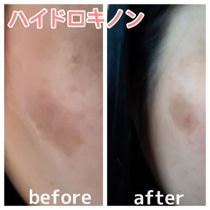 業務用ハイドロキノン/旭研究所/その他スキンケアを使ったクチコミ(1枚目)