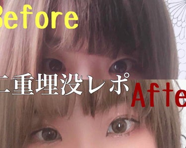 ※2枚目以降ダウンタイムの写真があります。ご注意ください。
二重埋没をしたので自分用メモを兼ねてレポします！


私…26歳　アイプチ歴10年　一重に近い奥二重
　　アイプチヘビーユーザーだけど癖はつか