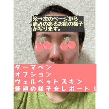 すみれ"25歳美容部員" on LIPS 「今日はダーマペンとオプションのヴェルベットスキンを受けてきまし..」（1枚目）