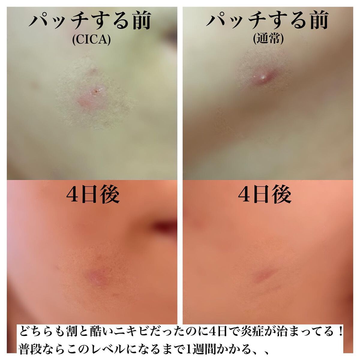 ゼロスポットパッチ/Today’s Cosme/にきびパッチを使ったクチコミ（3枚目）