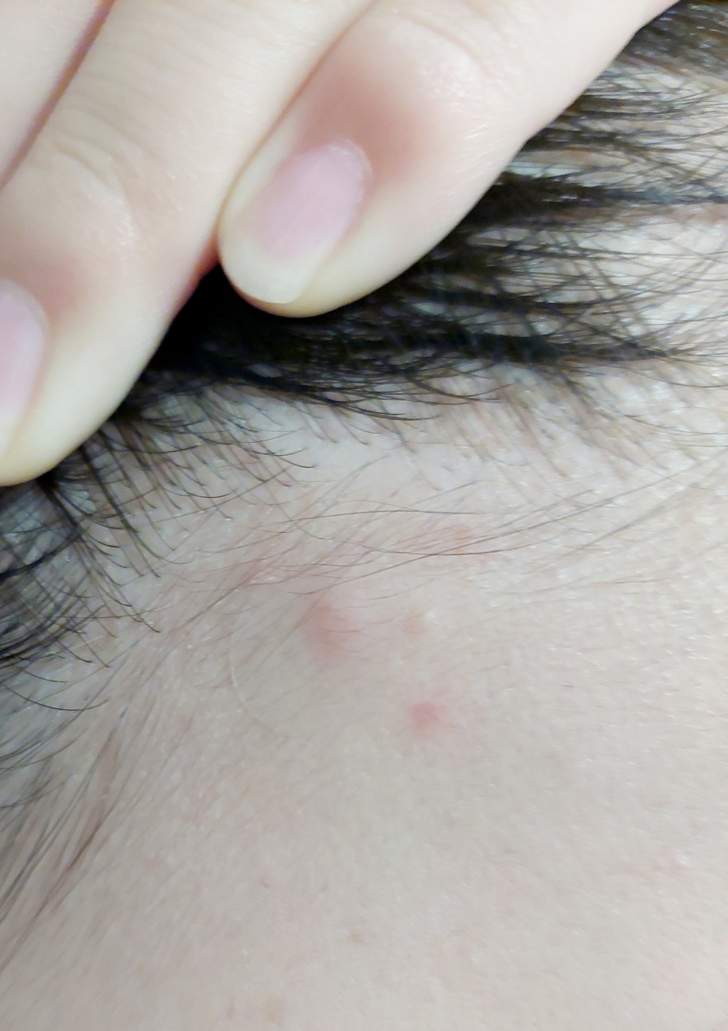 極薄透明パッチ nikipa!/金冠堂/にきびパッチを使ったクチコミ（3枚目）