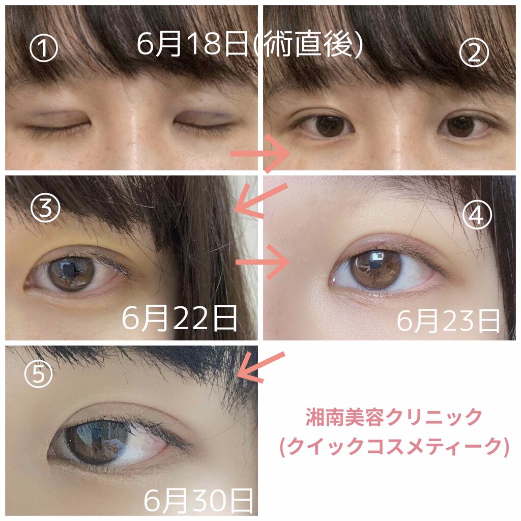 みるきぃ𓂃 𓈒𓏸 on LIPS 「先日、湘南美容クリニックで二重整形(埋没)をしてきました。術後..」(2枚目)