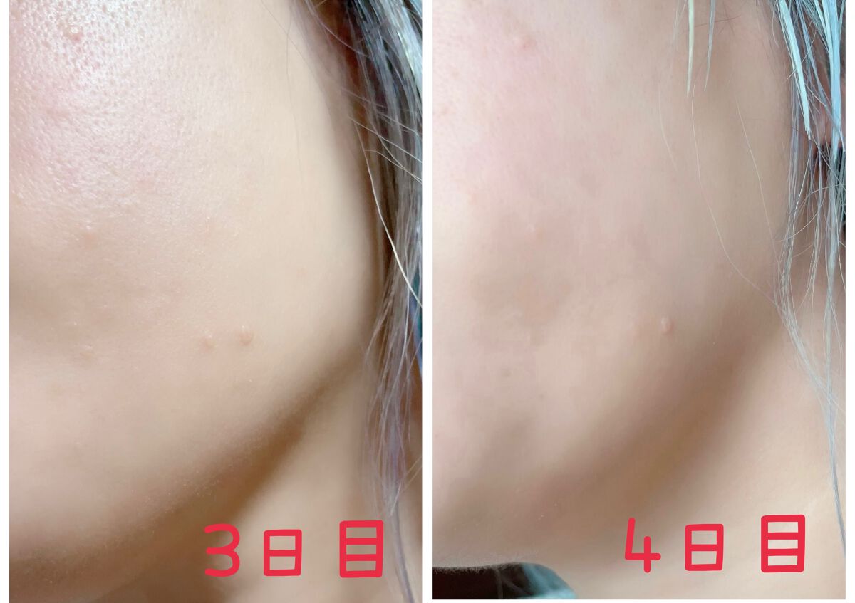 ミラクルアクネクリアスポットトリートメント/SOME BY MI/美容液を使ったクチコミ(5枚目)