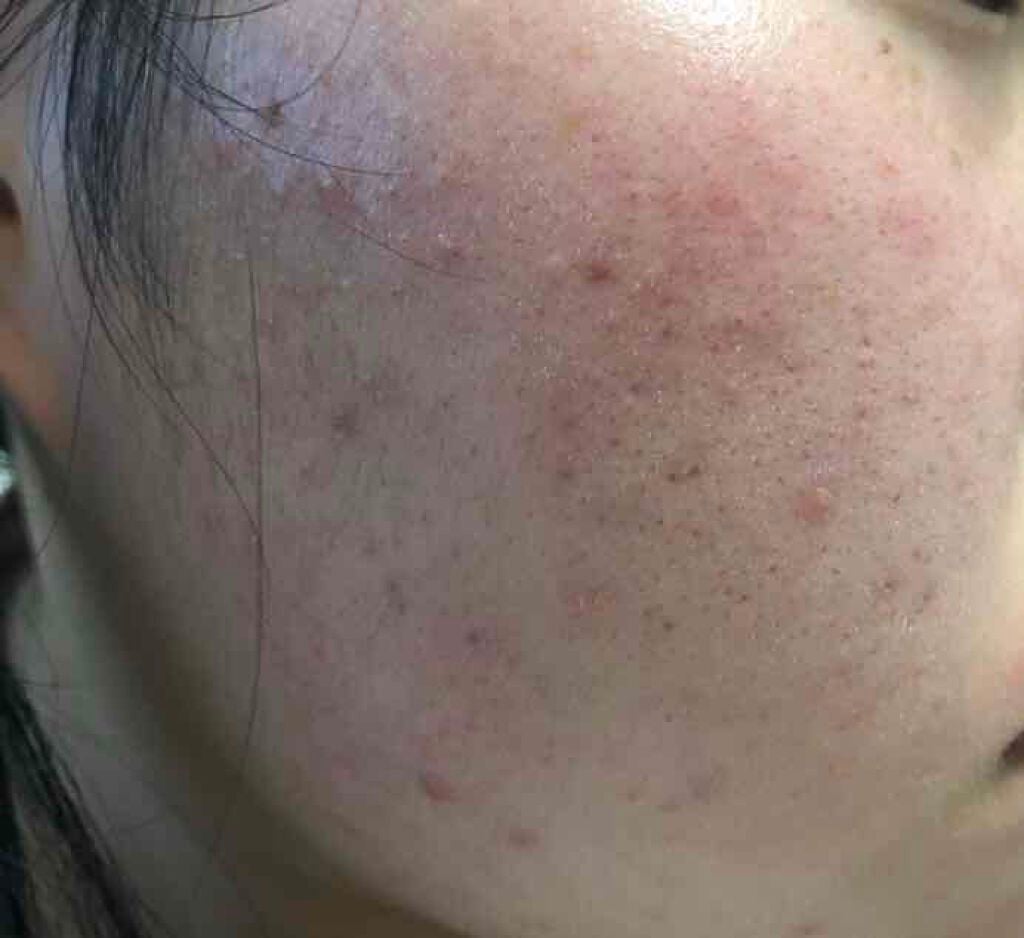 薬用保湿化粧水/オードムーゲ/化粧水を使ったクチコミ(3枚目)