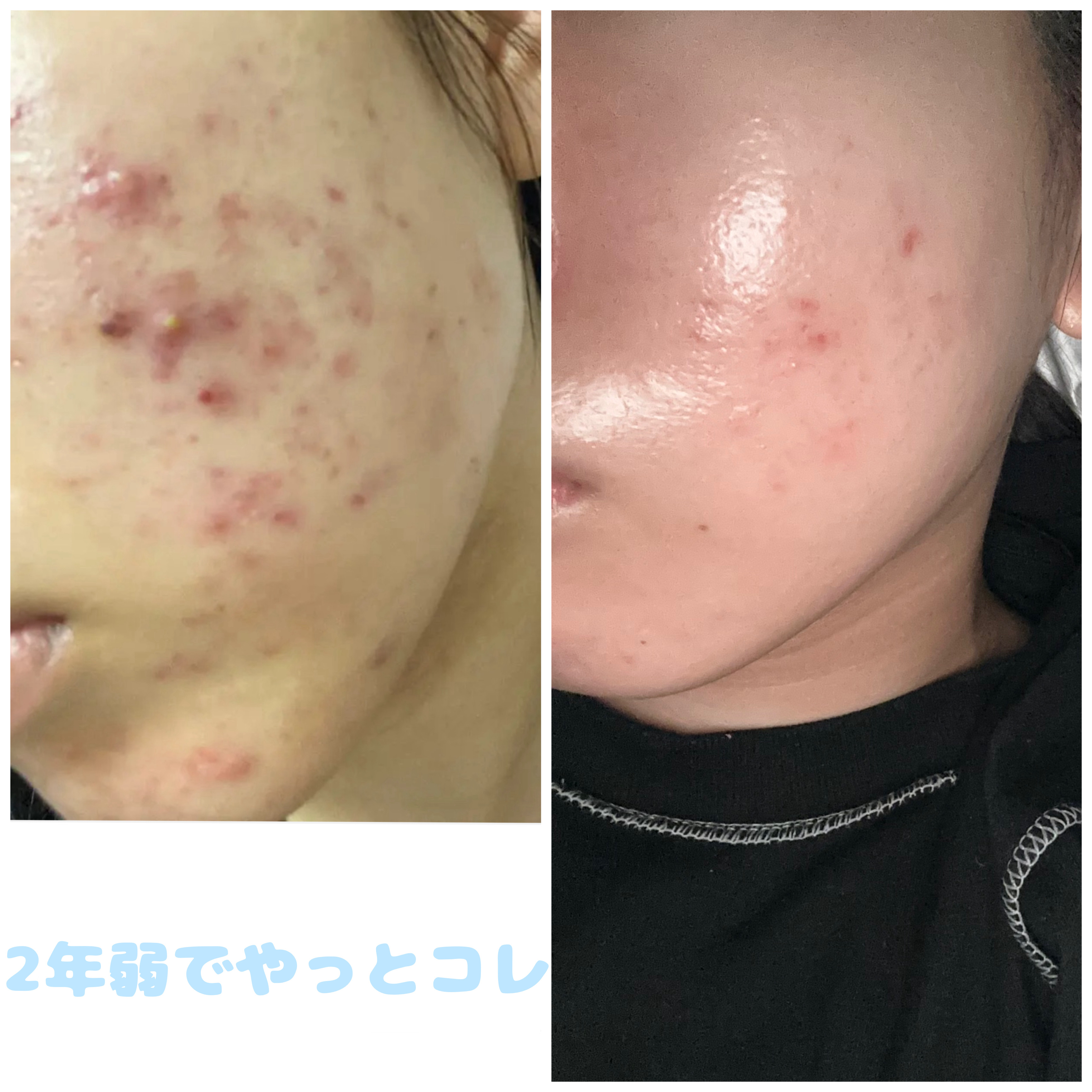 潤浸保湿 乳液/キュレル/乳液を使ったクチコミ（1枚目）