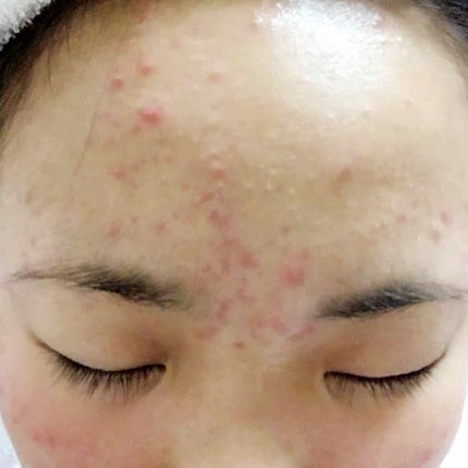 薬用 しみ 集中対策 美容液/メラノCC/美容液を使ったクチコミ(3枚目)