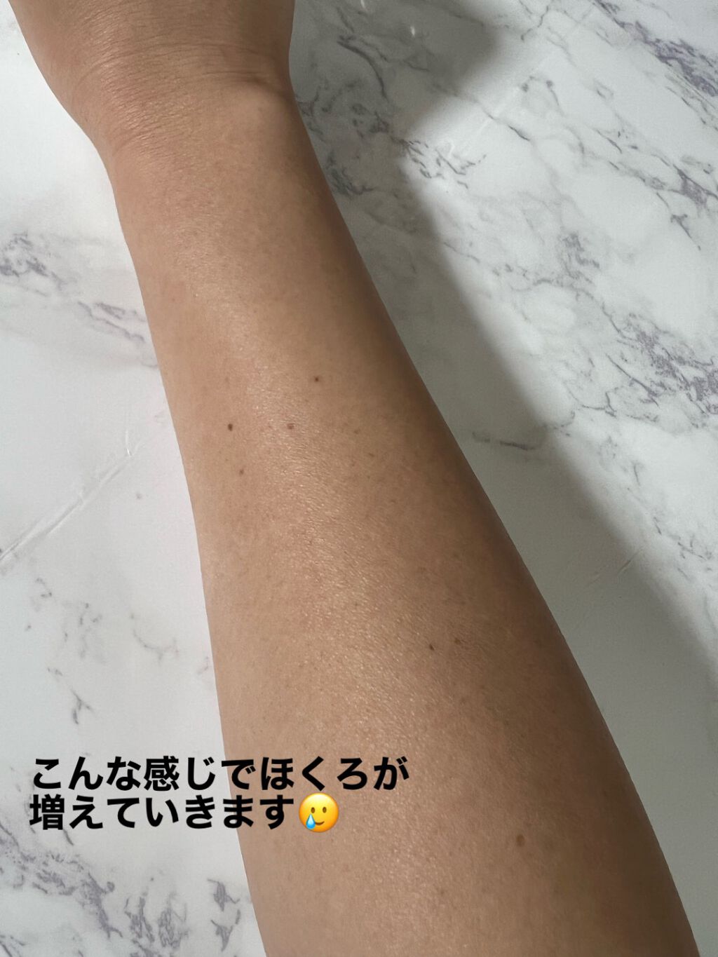 ひまわり on LIPS 「私が顔のほくろを19個取ったお話📖お顔失礼します🙇♀️前の写..」(2枚目)