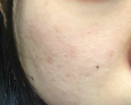 薬用しみ対策 美白化粧水/メラノCC/化粧水を使ったクチコミ(3枚目)