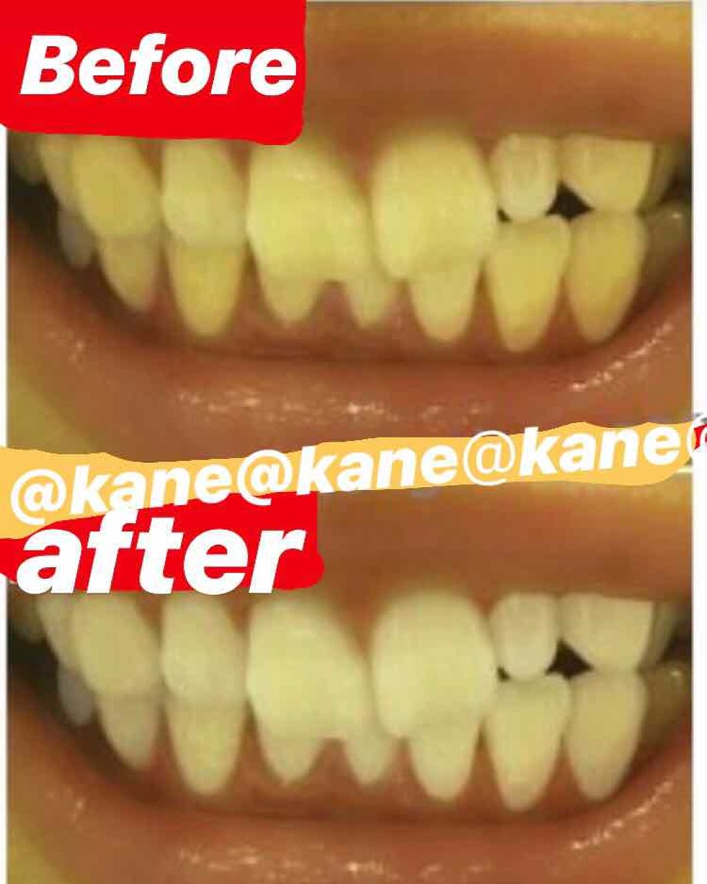 ミュゼホワイトニング 速攻美白 ポリリンキューブ 3個入り/ミュゼホワイトニング/歯磨き粉を使ったクチコミ(3枚目)