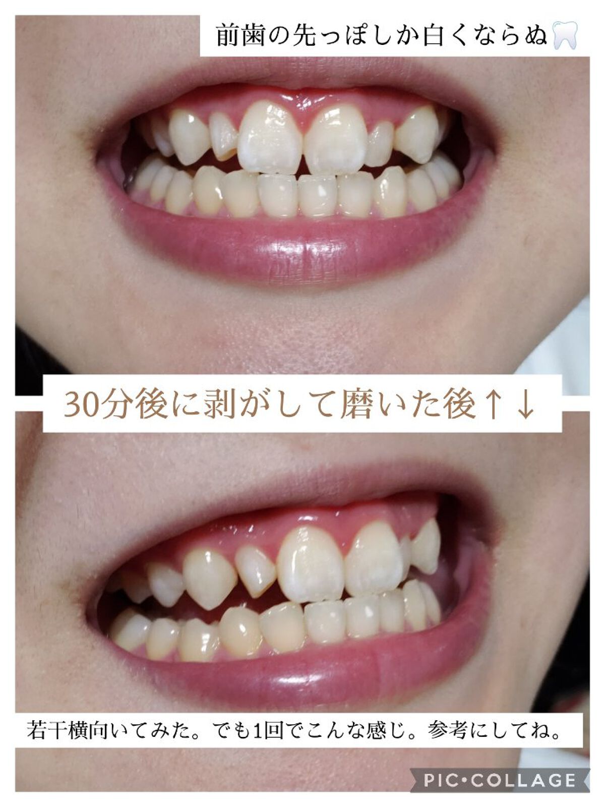 クレスト3Dホワイトニング ホワイトストリップ プロフェッショナル エフェクツ/クレスト/その他オーラルケアを使ったクチコミ(9枚目)
