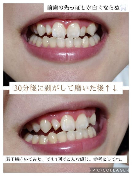 クレスト3Dホワイトニング ホワイトストリップ プロフェッショナル エフェクツ/クレスト/その他オーラルケアを使ったクチコミ(9枚目)