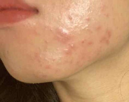 ディフェリンゲル0.1% /マルホ株式会社/その他を使ったクチコミ(1枚目)