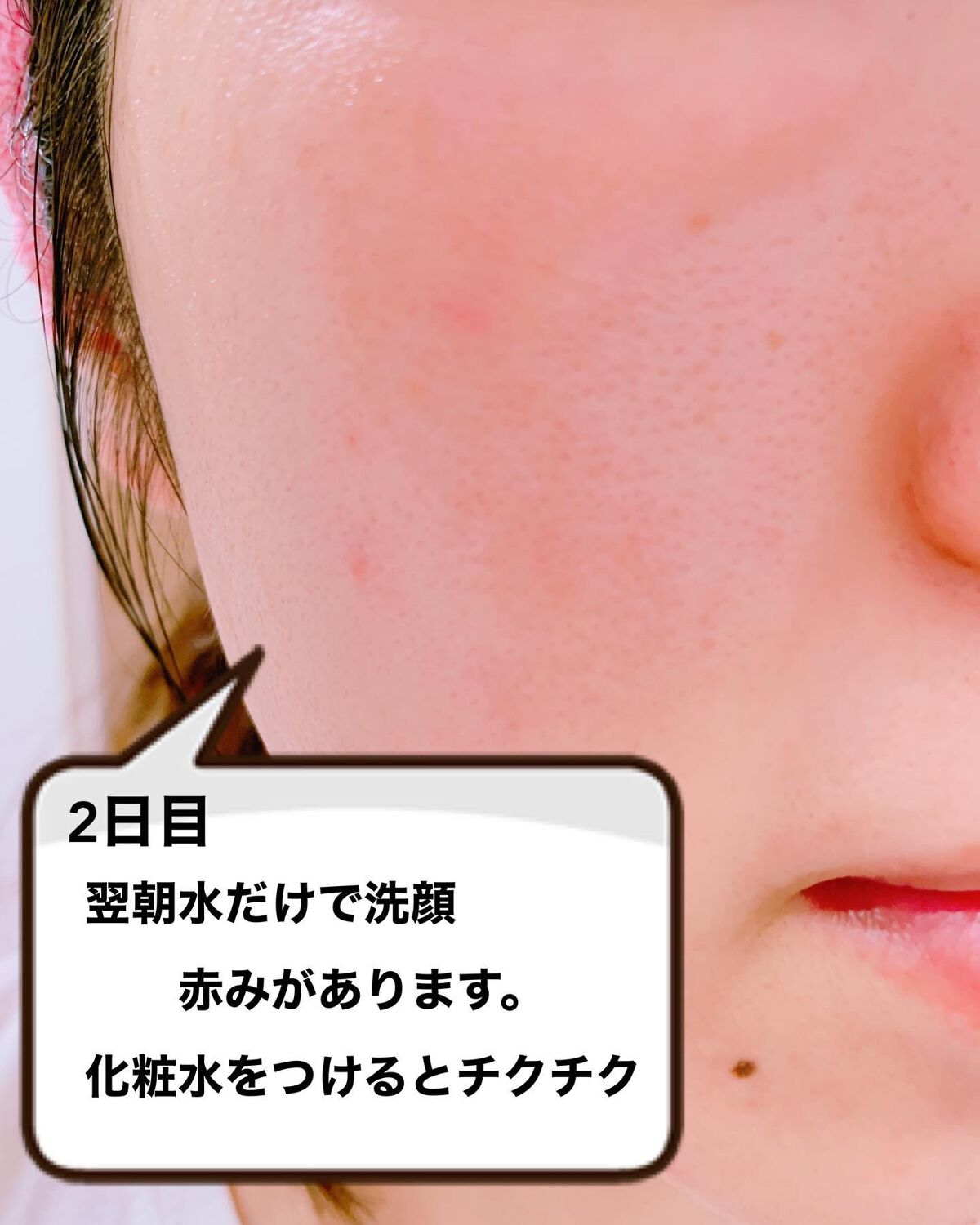 ダーマスキンピーリング|BQCELLの口コミ - * ♡ BQCELL DERMA ダーマスキンピーリング|BQCELLの口コミ - * ♡ BQCELL DERMA