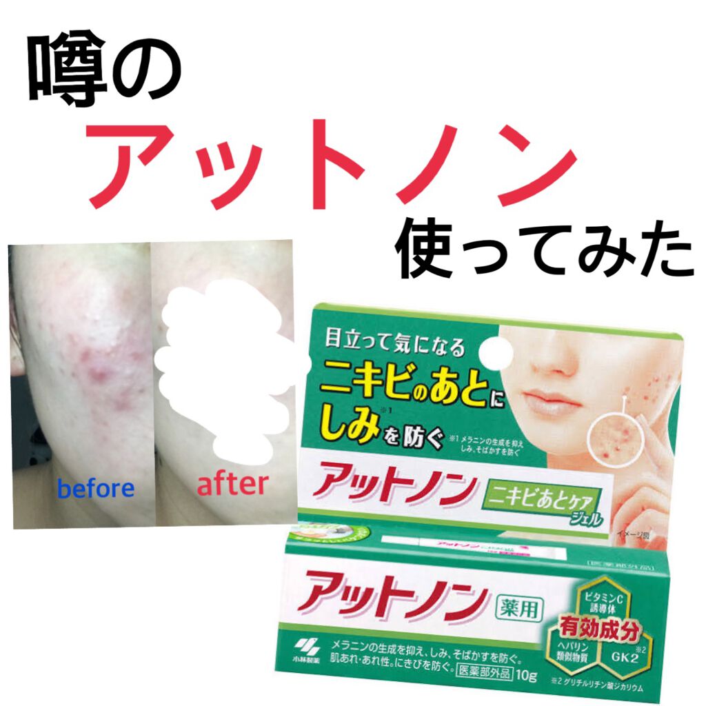 ãããããšã±ã¢ãžã§ã«/ã¢ãããã³/ãã®ä»ã¹ãã³ã±ã¢ã䜿ã£ãã¯ãã³ãïŒ1æç®ïŒ