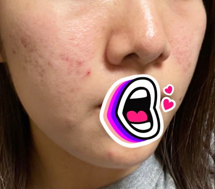 オードムーゲ 薬用ローション(ふきとり化粧水)/オードムーゲ/拭き取り化粧水を使ったクチコミ(3枚目)