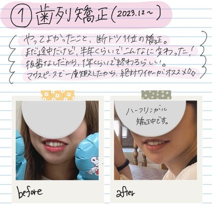 ãã€ãªãŒPD/ZO Skin Health/ãã§ã€ã¹ã¯ãªãŒã ã䜿ã£ãã¯ãã³ãïŒ2æç®ïŒ