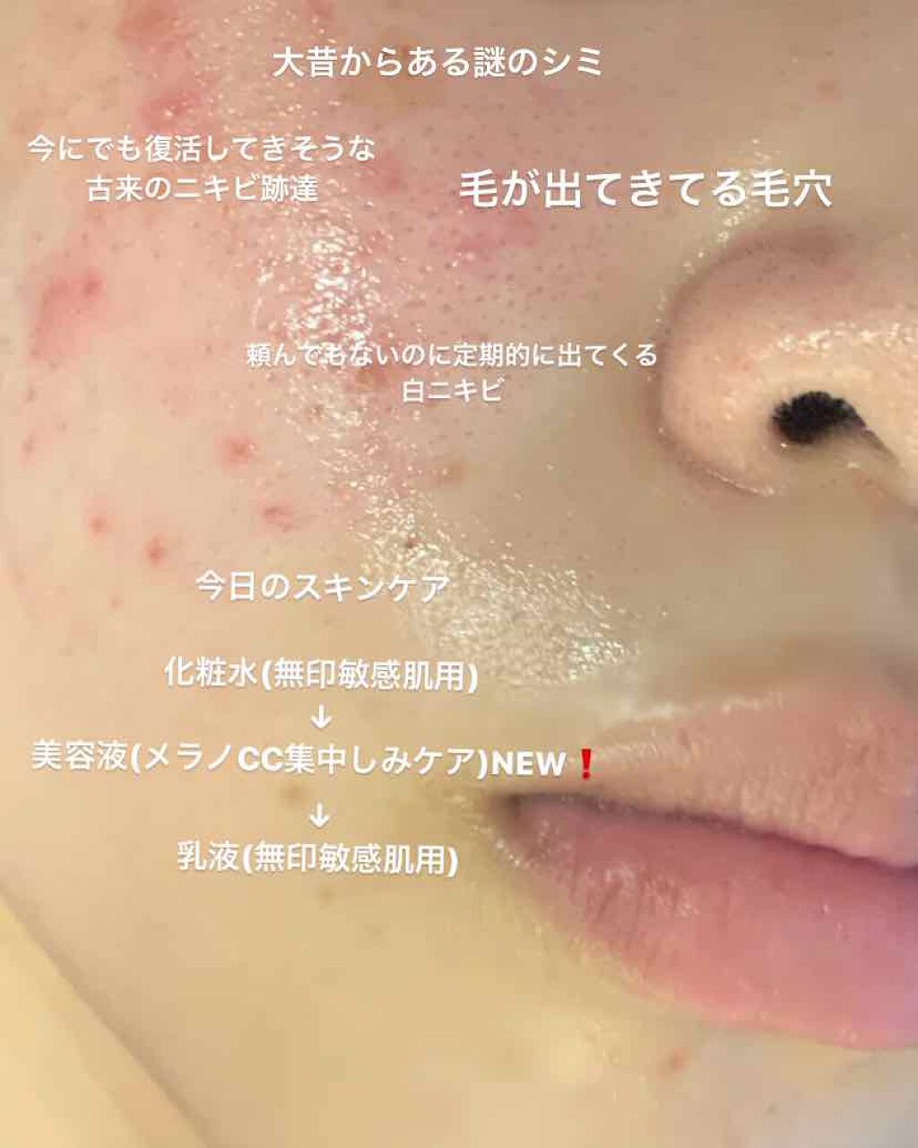 スキンケア洗顔料 薬用アクネケア/ビオレ/洗顔フォームを使ったクチコミ(3枚目)