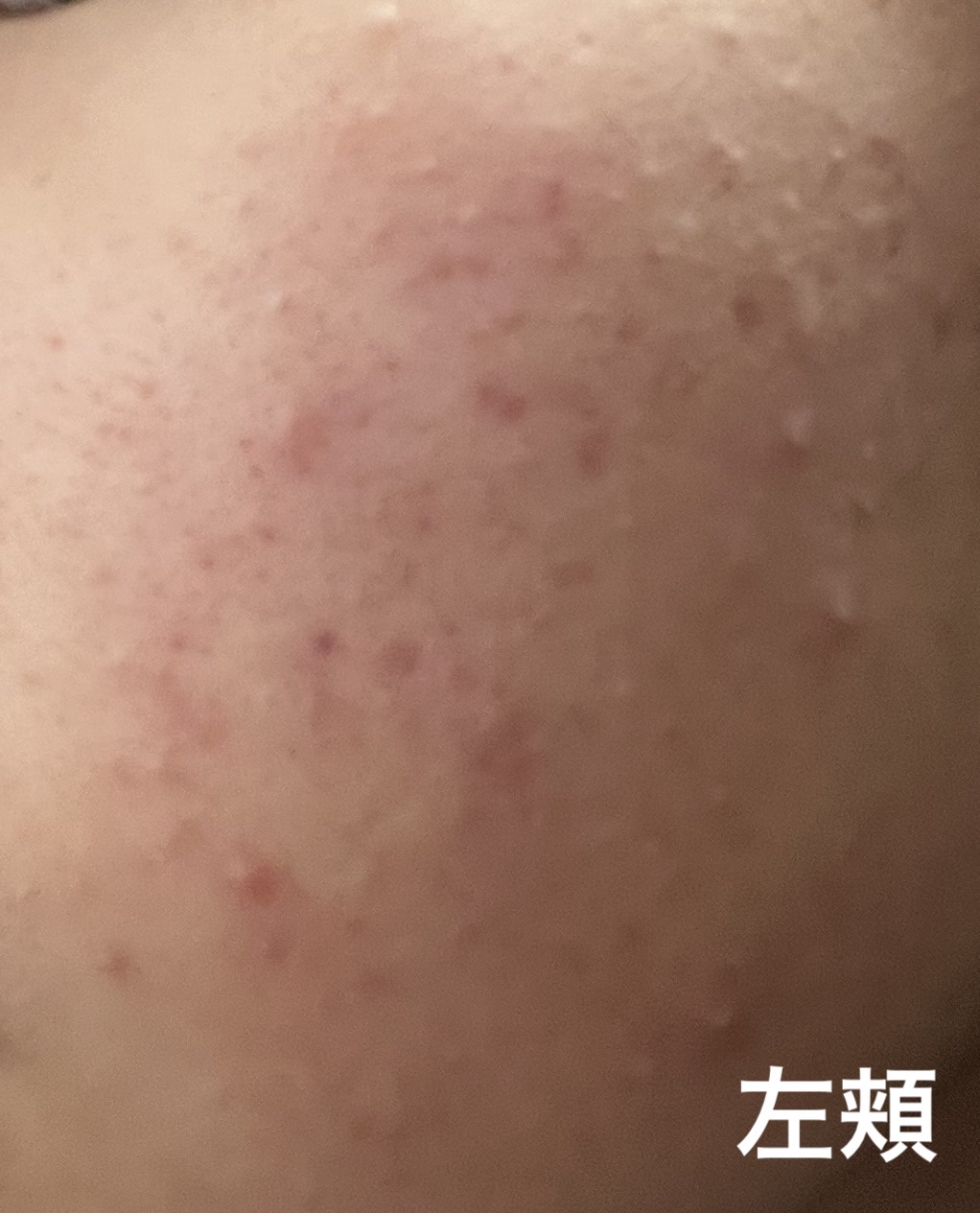 ニキビ治療薬(医薬品)/メンソレータム アクネス/その他を使ったクチコミ（2枚目）