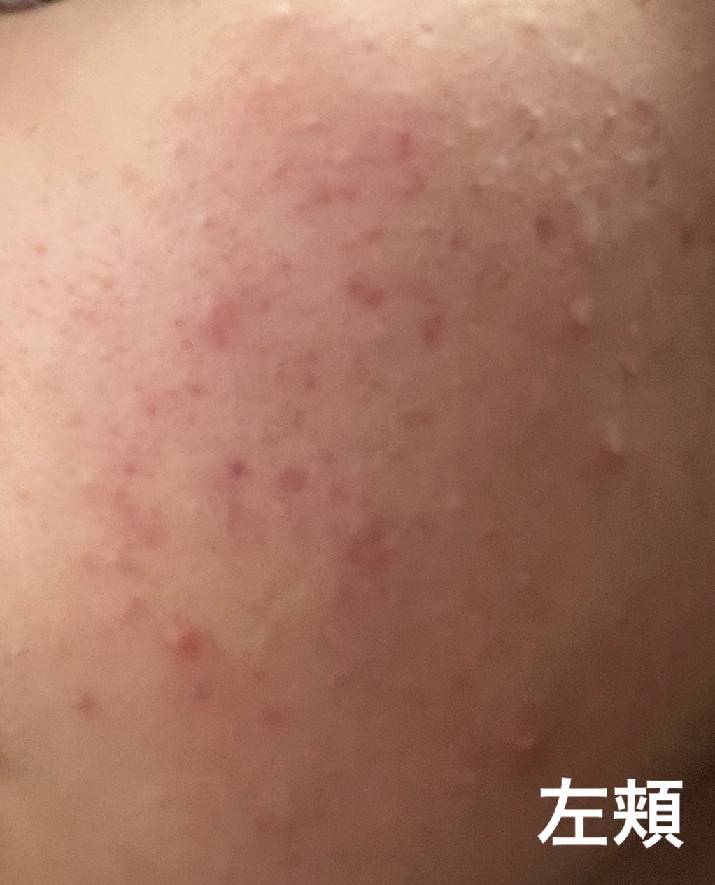 ニキビ治療薬(医薬品)/メンソレータム アクネス/その他を使ったクチコミ(2枚目)