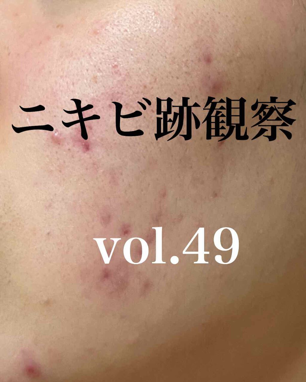 薬用アクネホワイトニング ジェル(部分用美容液)/DHC/美容液を使ったクチコミ(1枚目)