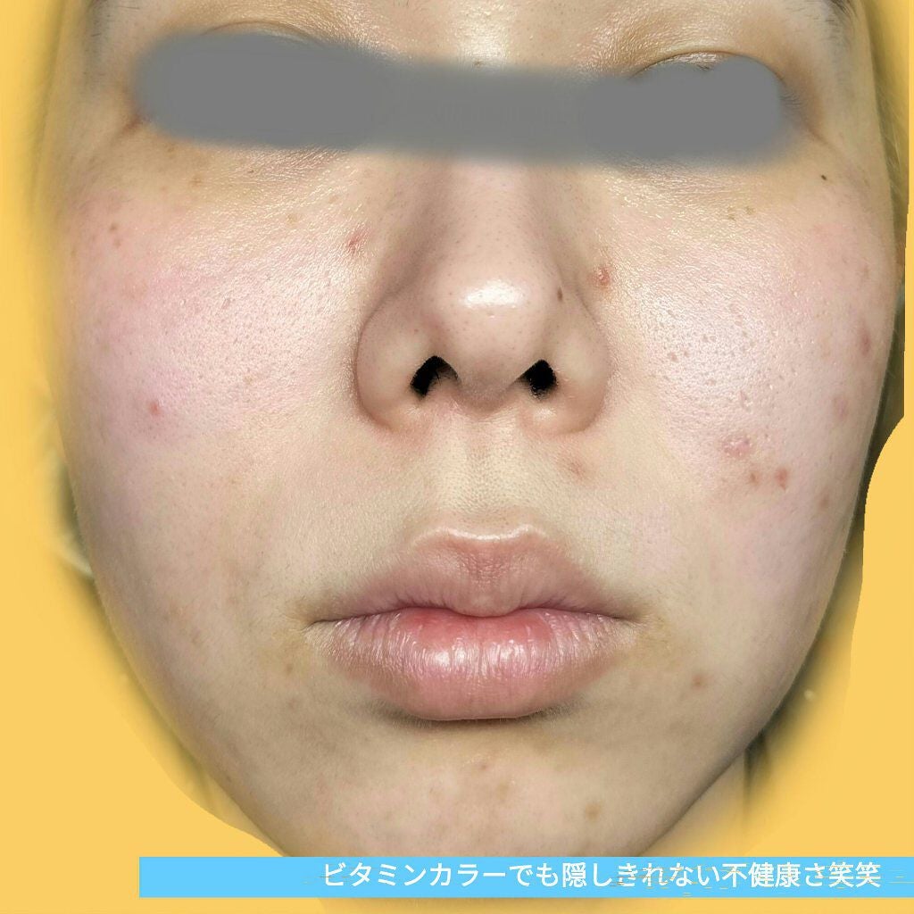 オードムーゲ 薬用ローション(ふきとり化粧水)/オードムーゲ/拭き取り化粧水を使ったクチコミ(2枚目)