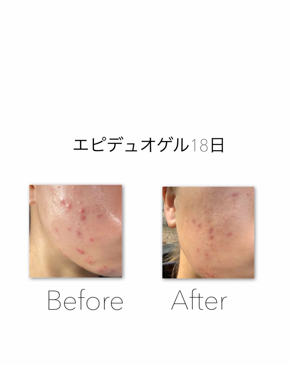 エピデュオゲル/マルホ株式会社/その他を使ったクチコミ（1枚目）