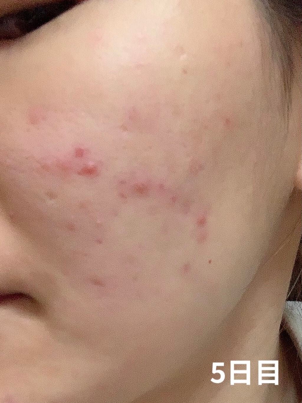 Tð on LIPS ããããæ²»çè¬ã¢ã¯ã¢ãã ã¯ãªãŒã ã®çµéã§ãðå¡ãå§ããŠãã1é±é..ãïŒ7æç®ïŒ