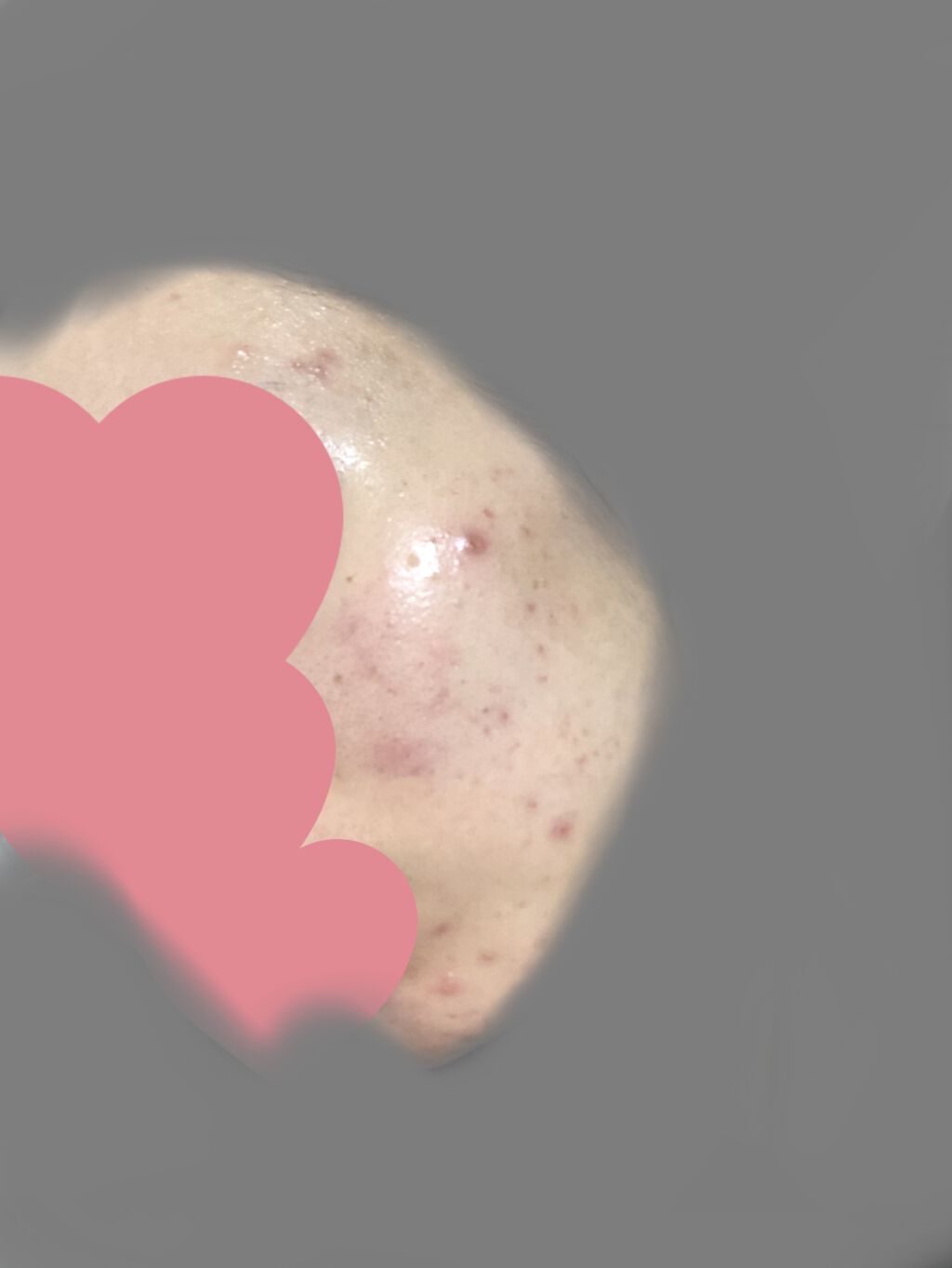 ベピオゲル/マルホ株式会社/その他を使ったクチコミ（1枚目）